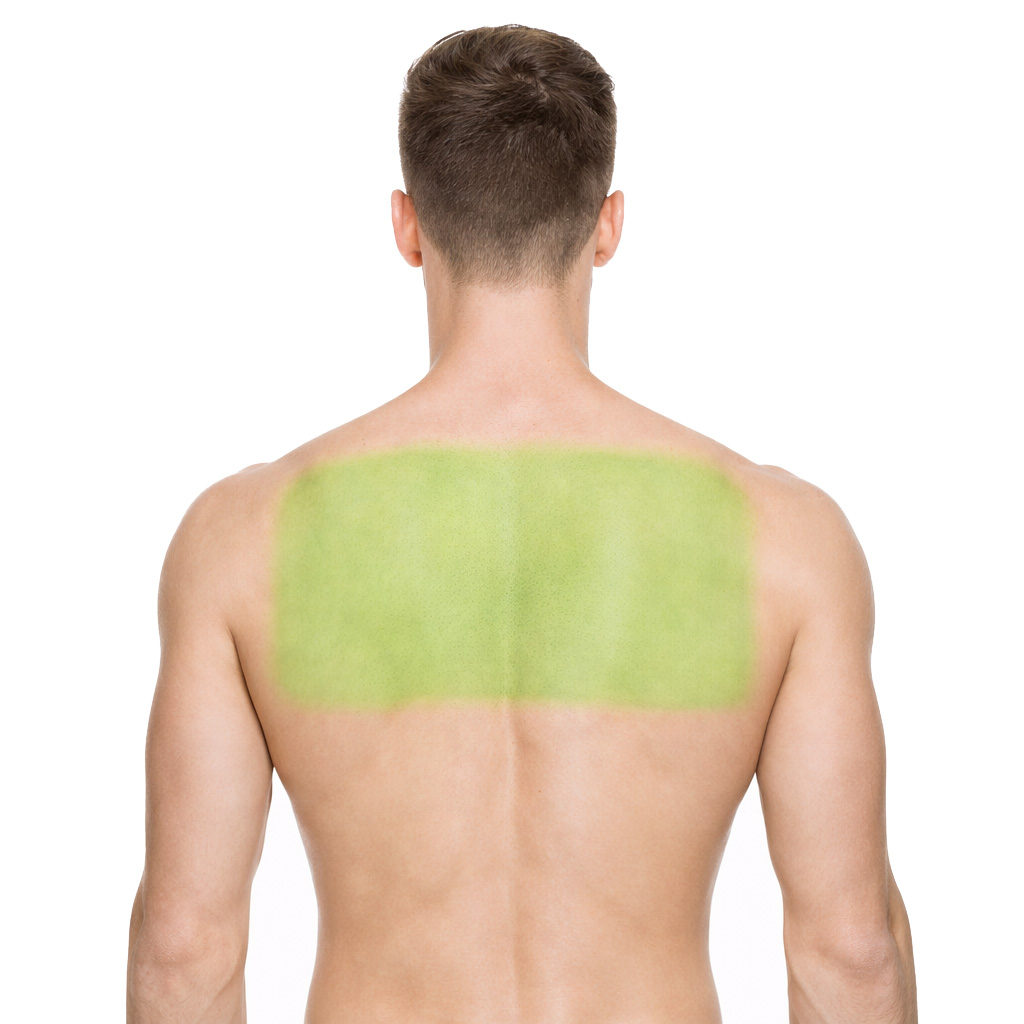 Back Laser Hair Removal - North York Clinic