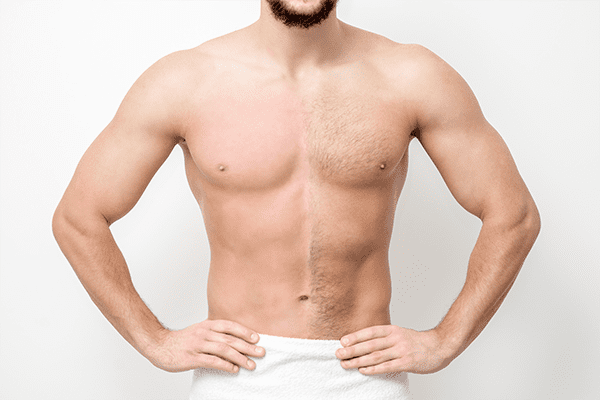 How Chest Hair Laser Removal Works
