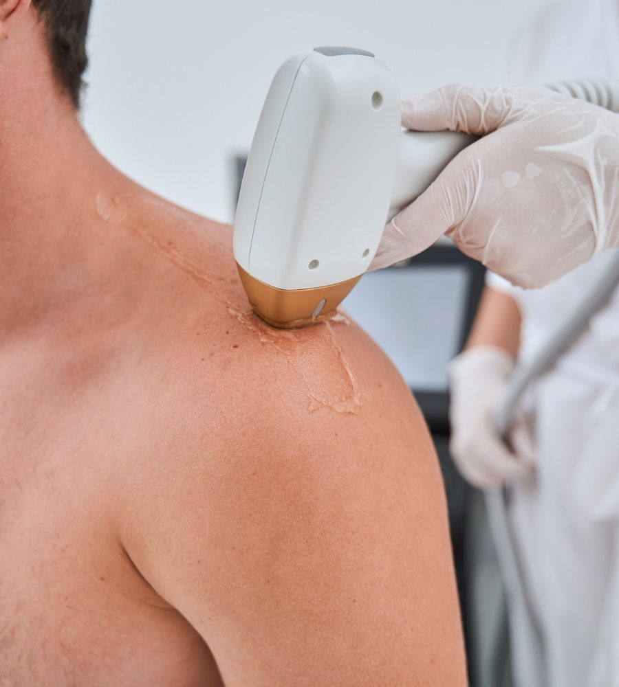 How shoulder Laser Hair Removal Works